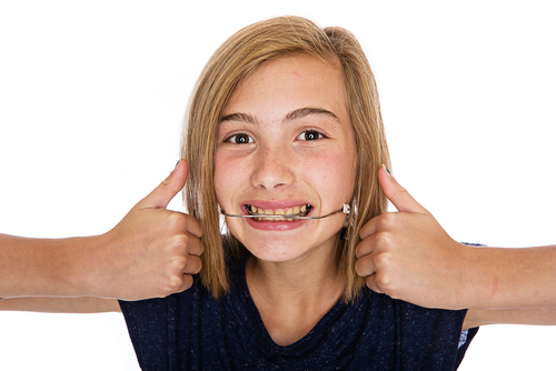 How A Misaligned Smile Can Be Perfected With Headgear Braces