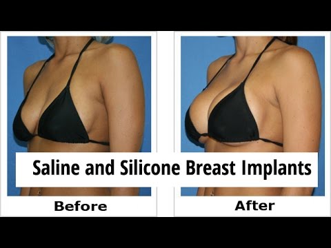 The4 S’s To Consider When Undergoing Breast Augmentation