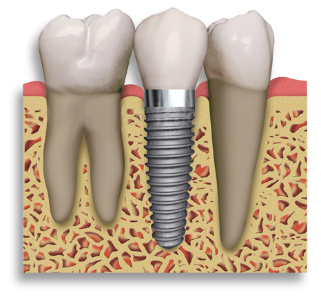 Dental_Implant_2_teeth.204153719_std