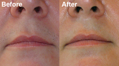 Preparing For A Successful Upper Lip Laser Hair Removal Procedure