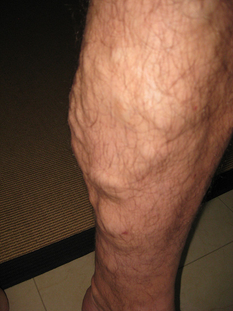 How Effective Is Sclerotherapy At Varicose Vein Removal