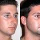 Things That You Need To Know About Rhinoplasty