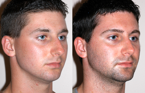 Things That You Need To Know About Rhinoplasty