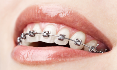 What You Need To Know About Malocclusion
