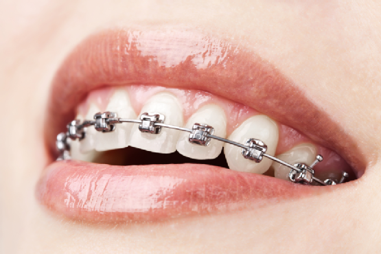 What You Need To Know About Malocclusion