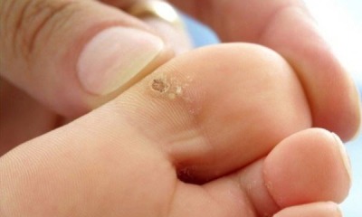 Explore Wart Removal Treatment