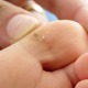 Explore Wart Removal Treatment