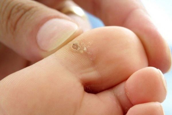 Explore Wart Removal Treatment