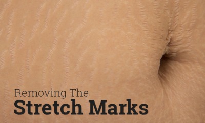 removing-the-stretch-marks