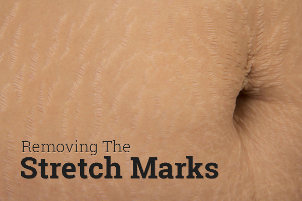 removing-the-stretch-marks