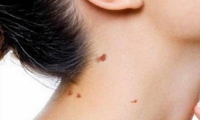 Remedies For Removing Mole From The Body And Face