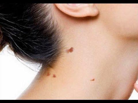 Remedies For Removing Mole From The Body And Face