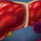 Proper Treatment In India For Liver Cirrhosis
