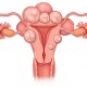 Uterine Fibroids: What Are Its Causes, Symptoms, and Treatments?
