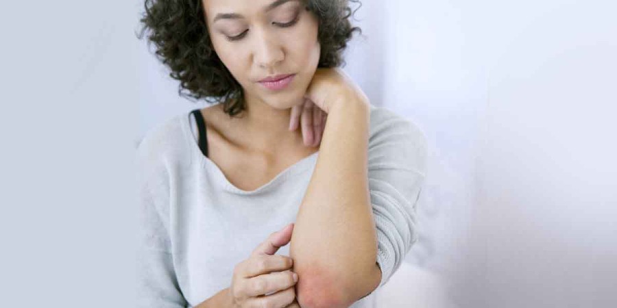 Tips to Reduce Eczema Flare-Ups